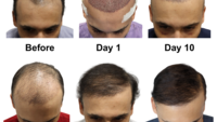 Get Natural-Looking Hair Transplants in Ahmedabad Now
