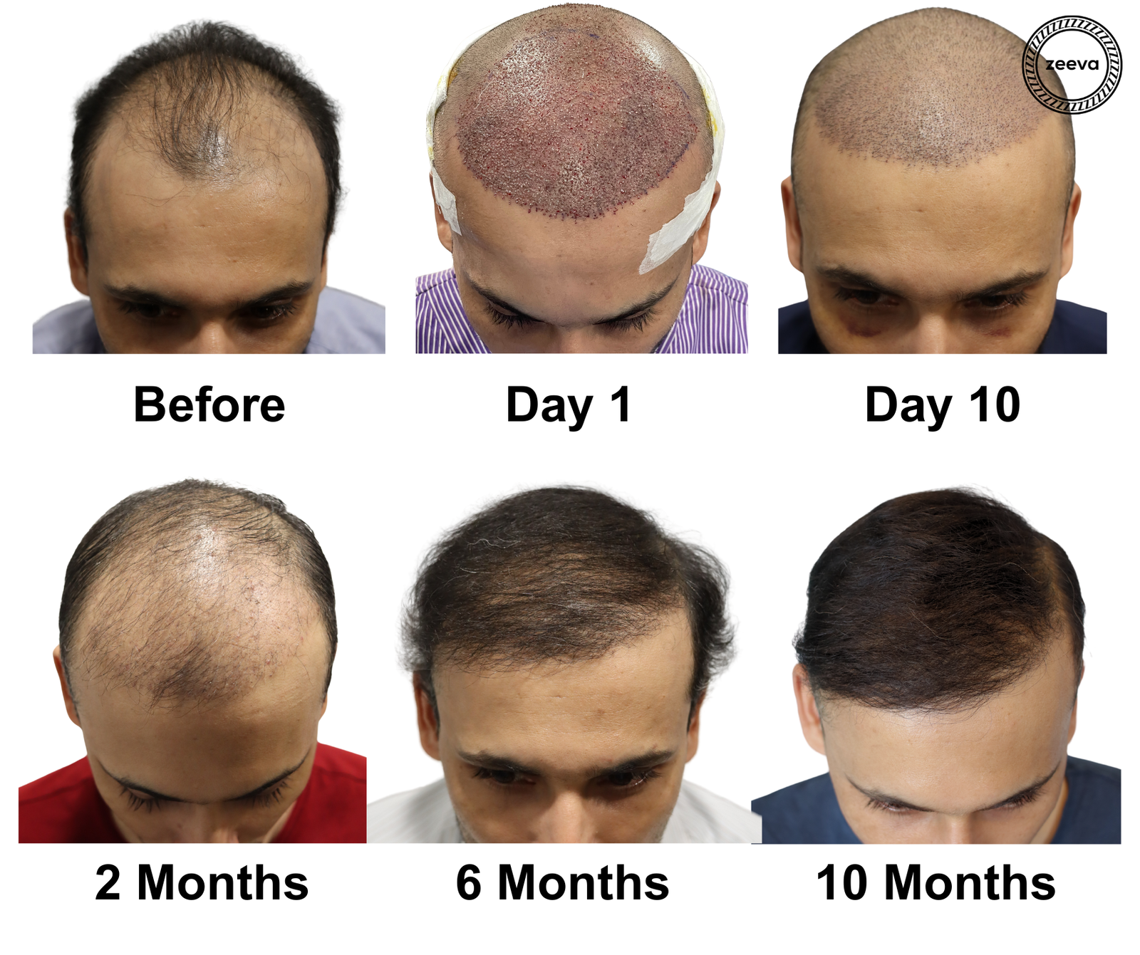 This Hair Replacement Clinic Promises a Full Head of Hair—In Just Weeks!
