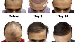 This Hair Replacement Clinic Promises a Full Head of Hair—In Just Weeks!