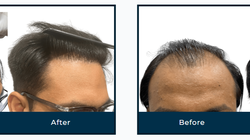 What No One Tells You About Hair Loss Treatment in Ahmedabad — Until You See the Results!