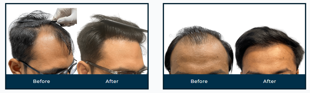 What No One Tells You About Hair Loss Treatment in Ahmedabad — Until You See the Results!